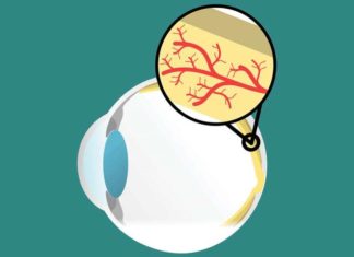 Macular degeneration linked to aging immune cells