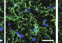 Multiple Sclerosis Drug Could Reduce Painful Side Effects of Common Cancer Treatment
