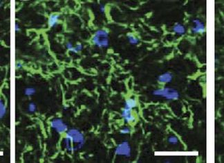 Multiple Sclerosis Drug Could Reduce Painful Side Effects of Common Cancer Treatment