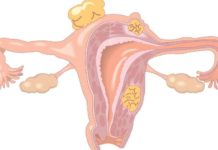 New clues to restoring fertility in women with disabling ovary disorder