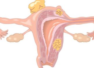 New clues to restoring fertility in women with disabling ovary disorder