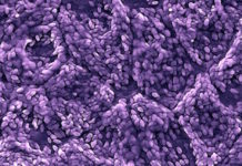 Researchers test stem cell-based retinal implant for common cause of vision loss