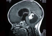 Single-cell study in a childhood brain tumor affirms the importance of context