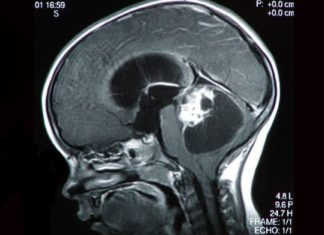 Single-cell study in a childhood brain tumor affirms the importance of context