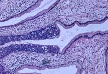 There’s a better way to screen for cervical cancer