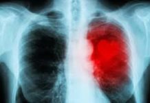Women most at risk for heart failure weeks after giving birth