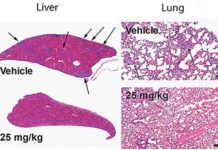 A dirty bomb battles cancer metastasis