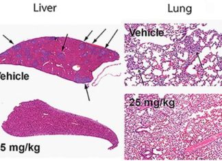 A dirty bomb battles cancer metastasis