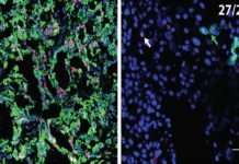 A way to prevent pancreatic cancer from spreading post-surgery?