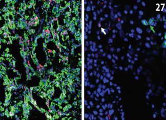 A way to prevent pancreatic cancer from spreading post-surgery?