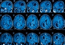 Brain cancer vaccine effective in some patients