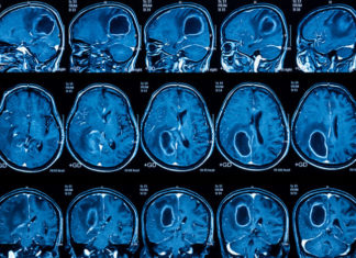Brain cancer vaccine effective in some patients