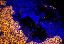 Enzyme blocker stops growth of deadly brain tumor