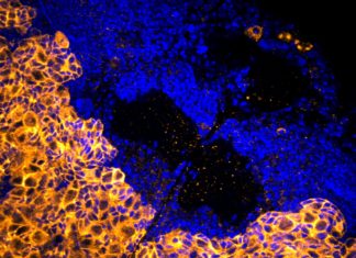 Enzyme blocker stops growth of deadly brain tumor