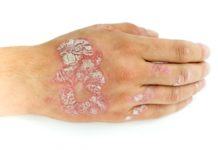 Insight into potential new strategy to target skin diseases like psorias