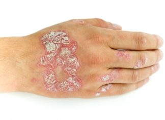 Insight into potential new strategy to target skin diseases like psorias