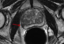 MRI to Diagnose Prostate Cancer