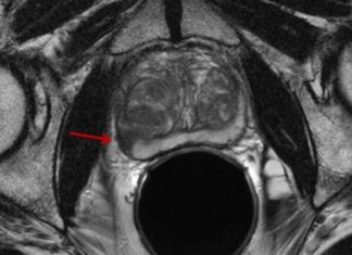 MRI to Diagnose Prostate Cancer