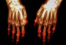 Researchers have identified a genetic overlap between rheumatoid arthritis and Huntington’s disease