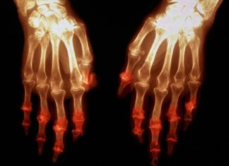 Researchers have identified a genetic overlap between rheumatoid arthritis and Huntington’s disease