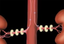 Surgery involving ultrasound energy found to treat high blood pressure