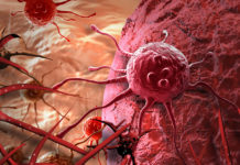Tiny Particles Could Help Fight Brain Cancer