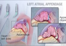 To have or not to have… your left atrial appendage closed
