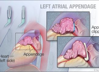 To have or not to have… your left atrial appendage closed