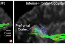 Young people with conduct disorder have abnormal connectivity between the prefrontal cortex and amygdala, researchers report