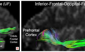 Young people with conduct disorder have abnormal connectivity between the prefrontal cortex and amygdala, researchers report