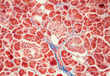 A gene previously linked with obesity has been found to affect how the body processes insulin, with potential implications for some forms of diabetes