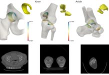 A new quantitative 3D analysis technique could lead to improved arthritis treatment