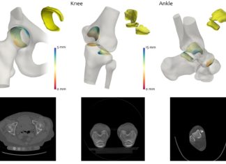 A new quantitative 3D analysis technique could lead to improved arthritis treatment