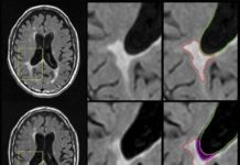 A new study reports the atrophy of brain lesion volume predicts the development of more physical disabilities associated with multiple sclerosis