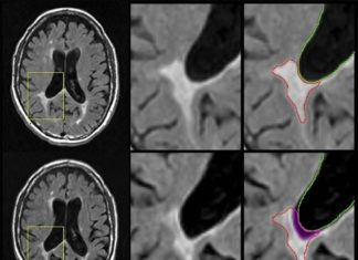 A new study reports the atrophy of brain lesion volume predicts the development of more physical disabilities associated with multiple sclerosis