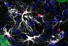 A new therapy proves effective against brain metastasis