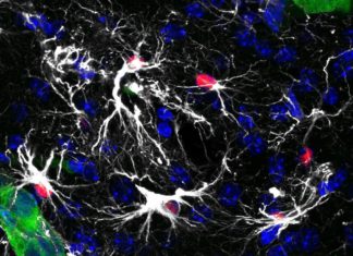 A new therapy proves effective against brain metastasis