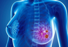 A novel approach to immunotherapy has led to the complete regression of breast cancer in a patient who was unresponsive to all other treatments