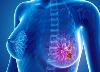 A novel approach to immunotherapy has led to the complete regression of breast cancer in a patient who was unresponsive to all other treatments