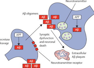 Report : Alcohol may impede the clearance of amyloid beta, a protein associated with Alzheimer’s disease, in the brain