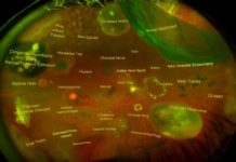 Alzheimer’s disease : the eye could be the window to brain degeneration