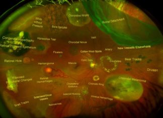 Alzheimer’s disease : the eye could be the window to brain degeneration