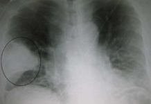 Antibiotic-resistant bacteria found in the US presents a triple threat