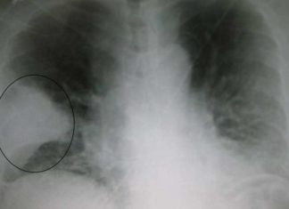 Antibiotic-resistant bacteria found in the US presents a triple threat