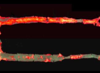 Antibody blocks inflammation, protects mice from hardened arteries and liver disease