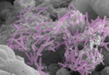 Cervical cancer may be driven by imbalance in vaginal bacteria