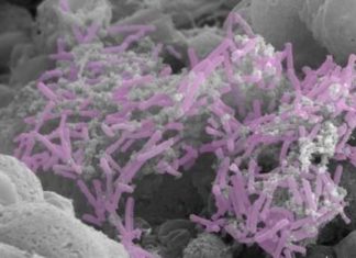 Cervical cancer may be driven by imbalance in vaginal bacteria