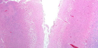 Electrically stimulating the brain may restore movement after stroke