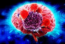 Experimental drug combined with radiation kills brain tumors in pre-clinical studies