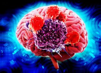 Experimental drug combined with radiation kills brain tumors in pre-clinical studies